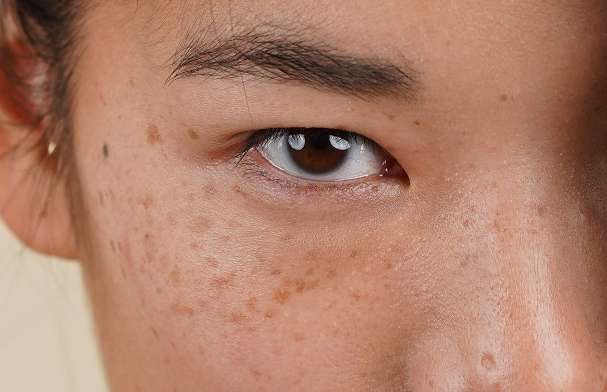 Vous ne savez plus quoi faire pour vos cicatrices d'acné ? Vous avez des taches sombres après un bouton ? Découvrez dans cet article quels sont les habitudes et ingrédients à adopter pour enfin retrouver un grain de peau lisse et uniforme. 